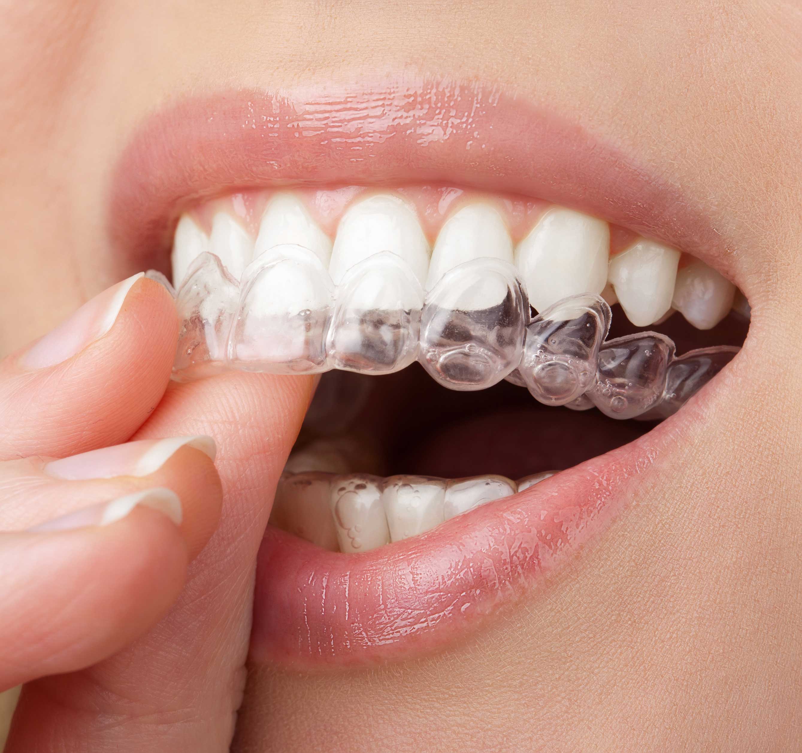 Clear Dental Aligner